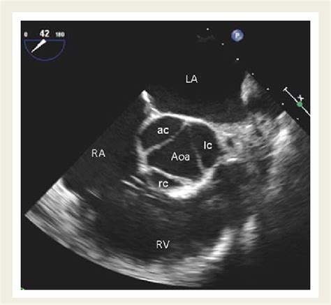 Parasternal Short Axis View Aortic Valve