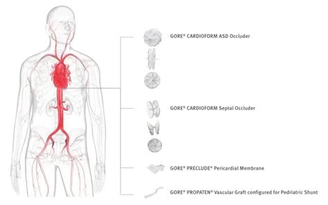 Cardiac medical devices | Gore Medical Europe