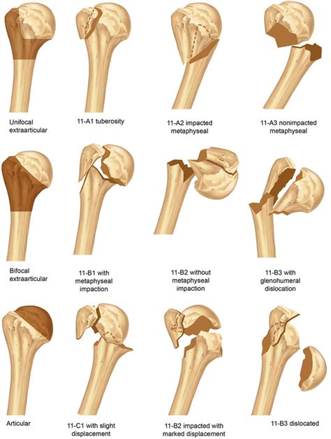 Proximal End Of Humerus Fracture