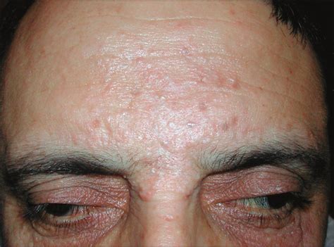 Multiple Apocrine Hidrocystoma of the Face Treated With a 1450-nm Diode Laser | Dermatology ...