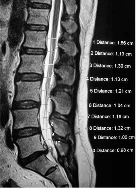 Sagittal view of L-S spine showing absolute stenosis at L5-S1 measuring... | Download Scientific ...