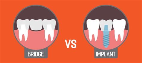 Dental Bridge Vs Implant | Monroe Family Dentistry