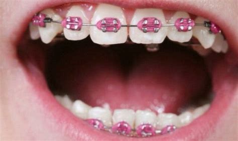 Pink Braces | Braces colors, Teeth braces, Pink braces