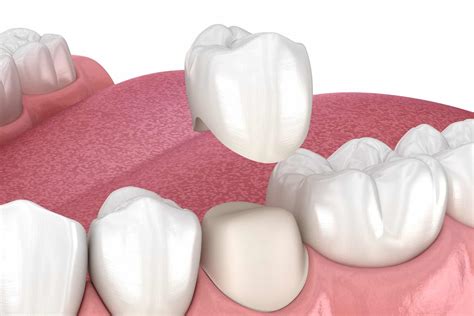 Dental Crowns & Bridges Post Operation Instructions - Online Dental Care