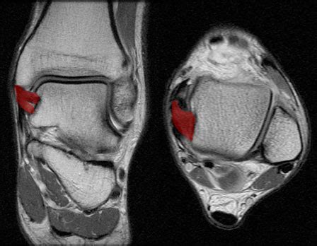 Radiology Anatomy Images : Deltoid ligament in Ankle MRI Anatomy