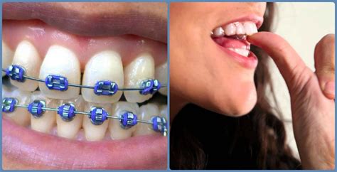 Edmond Dentist Explains clear aligners Vs. Metal Braces | Gray Dental Group | Edmond, OK 73034