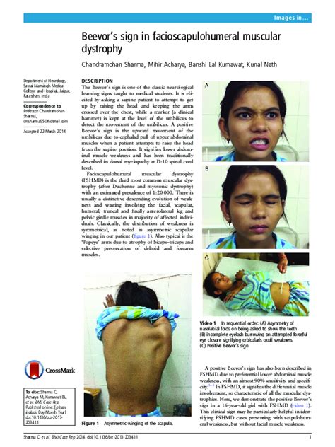 (PDF) Beevor's sign in facioscapulohumeral muscular dystrophy | mihir ranjan acharya and Kunal ...