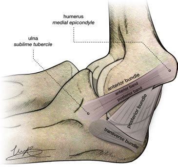 Ucl Ligament - Fpt Disorders Of The Elbow Ligaments Ucl Lucl Orthopaedicsone Articles ...