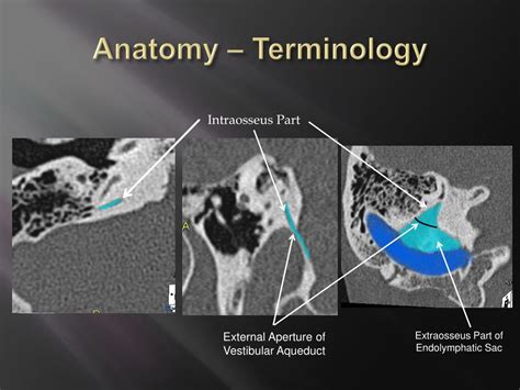 PPT - The Large Vestibular Aqueduct Syndrome in adults PowerPoint Presentation - ID:1052119