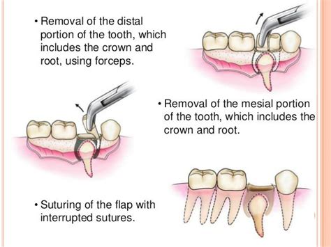 Principles and steps of surgical tooth extraction