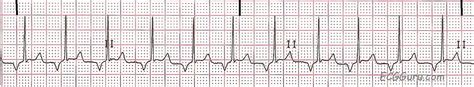 ECG Basics: Retrograde P Waves | ECG Guru - Instructor Resources