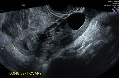 Ectopic pregnancy masquerading as a molar pregnancy – O&G Magazine