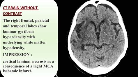 CASE 958 CT BRAIN cortical laminar necrosis - YouTube