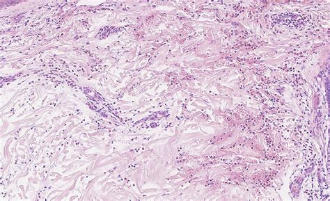 Endocardial biopsy showing clear extensive eosinophilic inflammation ...