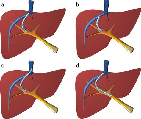 TIPS positioning. Illustration of transjugular intrahepatic ...