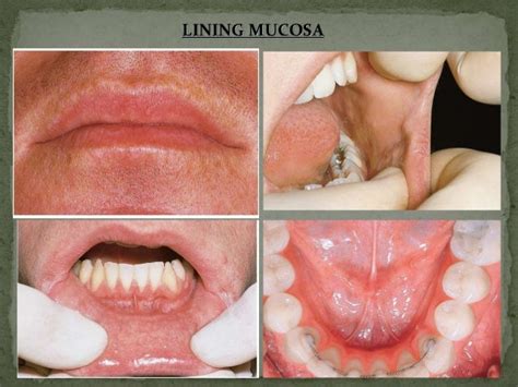 Oral mucous membrane