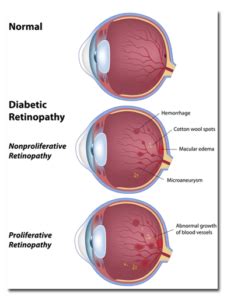 Diabetic Retinopathy Treatment | Eye Disease Procedures