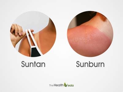 Sunburn vs suntan: Cara untuk hilangkan ~ IMAN ABDUL RAHIM