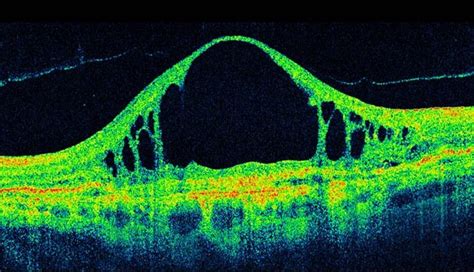 OCT 3D Eye Scans - Perspective Opticians Solihull