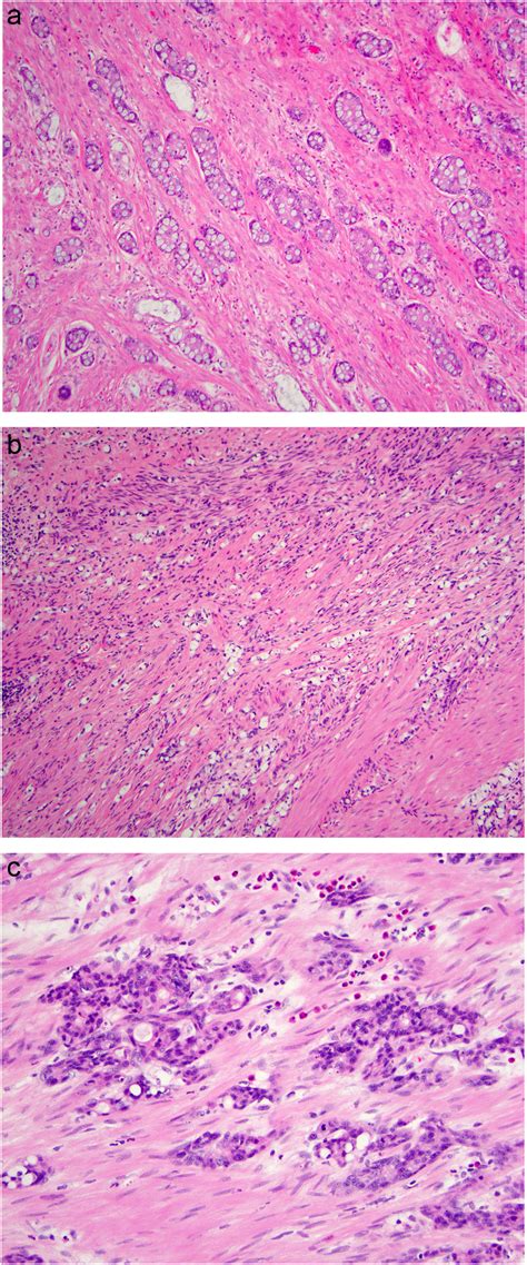 Mutational landscape of goblet cell carcinoids and adenocarcinoma ex goblet cell carcinoids of ...