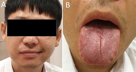 Recurrent facial palsy and fissured tongue - European Journal of ...