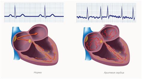 Heart rhythm disorders