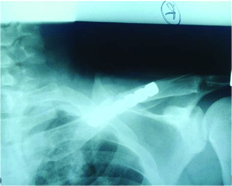 Clavicular X-ray Day 1 post operation. | Download Scientific Diagram