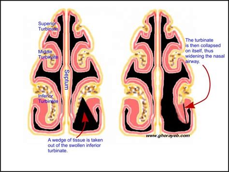 Turbinate Reduction Nasal (turbinectomy) Surgery In Iran | Medpersia Medical Tourism