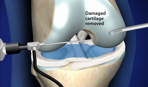 Acl surgery new procedure - lopasoil