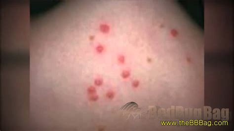 bed bug rash - YouTube