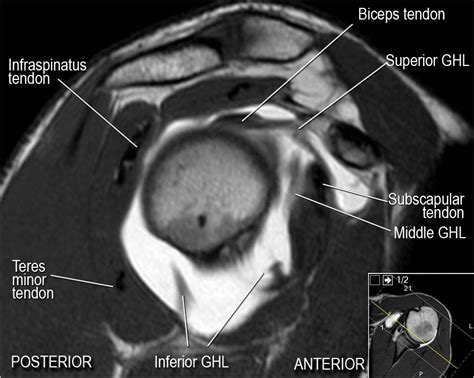 The Radiology Assistant : Shoulder MR - Anatomy