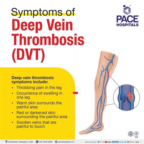 Deep Vein Thrombosis, DVT - Symptoms, Causes and Complications