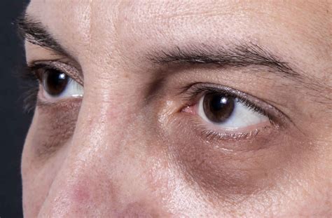 Dark circles under eyes causes & dark circles under eyes treatment