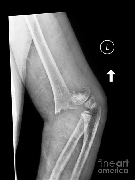 Broken Elbow, X-ray Photograph by Science Photo Library | Pixels