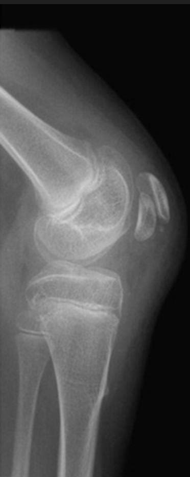 Multiple Epiphyseal Dysplasia (MED) - Pediatrics - Orthobullets