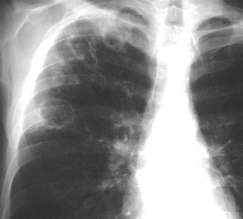 Imaging Manifestations of Blastomycosis: A Pulmonary Infection with Potential Dissemination ...