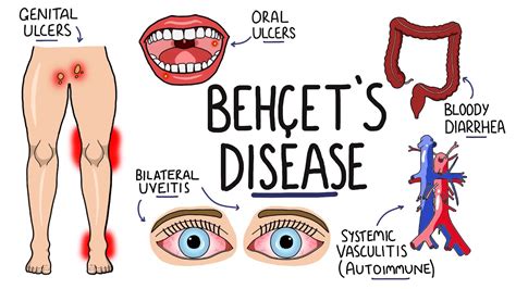 Behcets Disease - Signs and Symptoms (with Triad) | Pathophysiology | Criteria & Treatment - YouTube