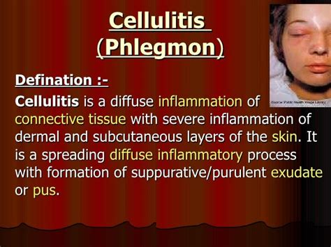 Cellulitis Face Treatment - Doctor Heck