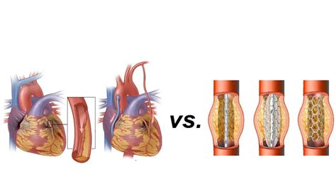 Study: Bypass better than stents for non-compliant patients - MassDevice