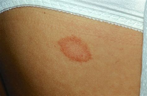 Pityriasis Rosea - Causes, Rash, Herald Patch, Stages, Treatment