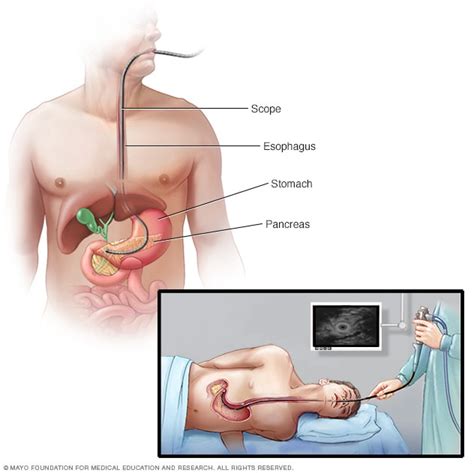 Endoscopic ultrasound - Mayo Clinic