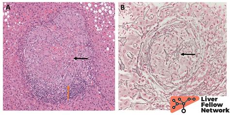 Pathology Pearls: Granulomatous Liver Diseases | AASLD