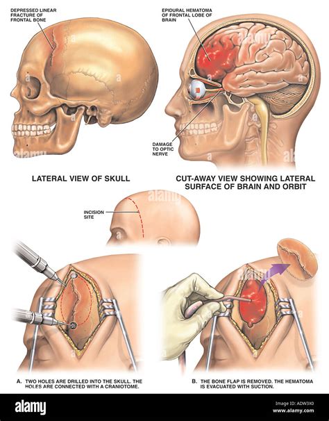 Closed Head Injury Stock Photo: 7711711 - Alamy