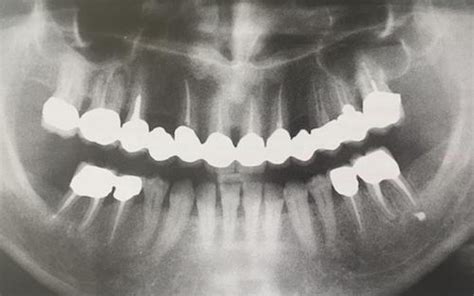 Diagnostic efficacy of orthopantomography in sinus disease | Dentistry33