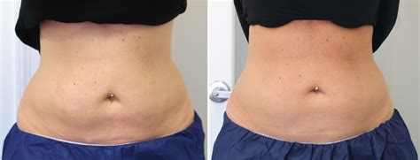 CoolSculpting Before & After - Stomach, Chin, Arms & More