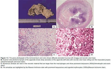 microbial-biochemical-technology-photograph-ileum-ulcerated