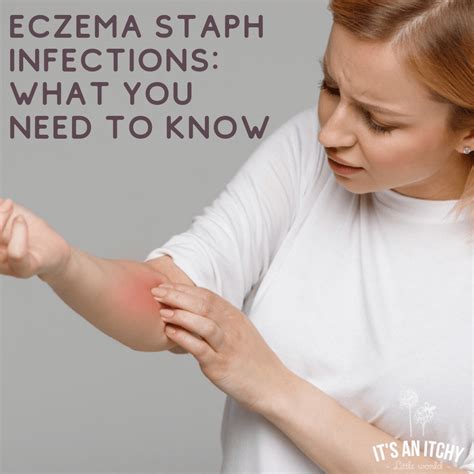 3 Types of Eczema Staph Infections to Be Aware Of