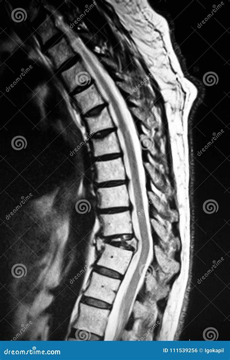 Thoracic Vertebrae Pathological Body Compression Mri Stock Photo - Image of pathological ...