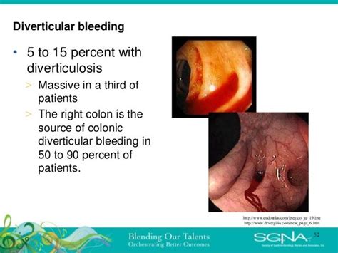 Diverticulitis: Popular Misconceptions & New Management rev 2019