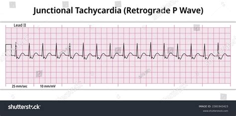 Junctional Tachycardia: Over 10 Royalty-Free Licensable Stock Vectors & Vector Art | Shutterstock